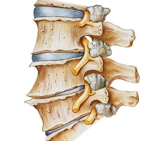 Clamping the nerve in the spine