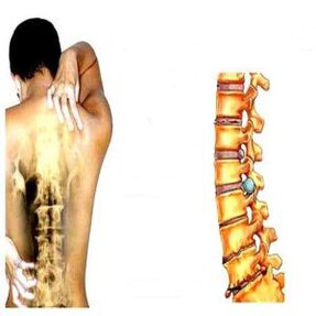 Stadiums of osteochondrosis