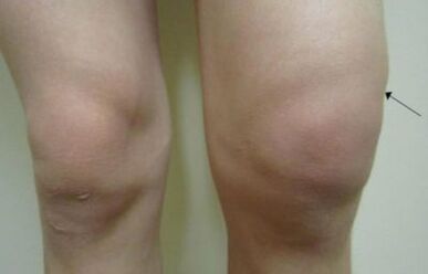 Clinical manifestations of the arthrosis of the knee joint