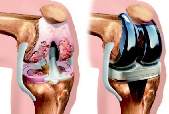 Before and after the endoprosthetics of the knee joint with osteoarthritis