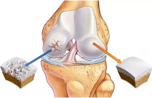 Healthy cartilage and cartilage, which is affected by arthrosis
