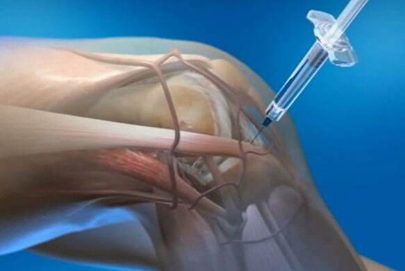 intra -karticular injections for the arthrosis of the knee joint