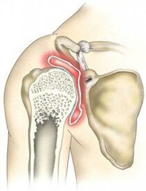 Destruction of the shoulder joint due to osteoarthritis