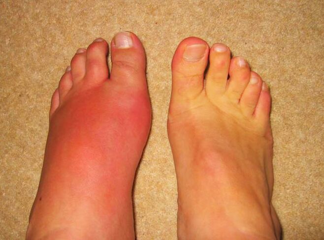 Pain in leg joints due to gout