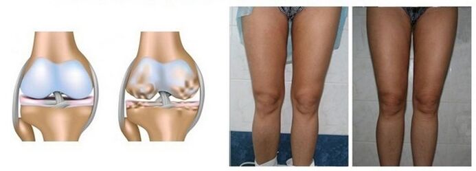 Defeat osteoarthritis of the knee joint with osteoarthritis